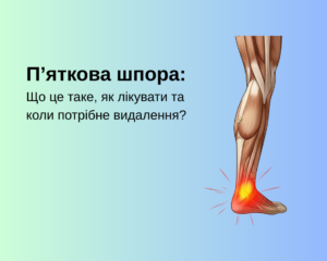 П’яткова шпора: що це таке, як лікувати та коли потрібне видалення