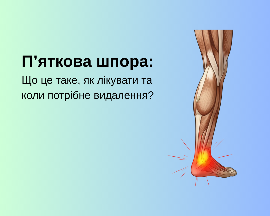 П’яткова шпора: що це таке, як лікувати та коли потрібне видалення