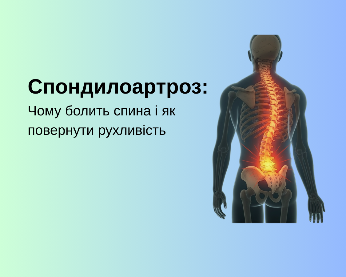 Спондилоартроз: Чому болить спина і як повернути рухливість
