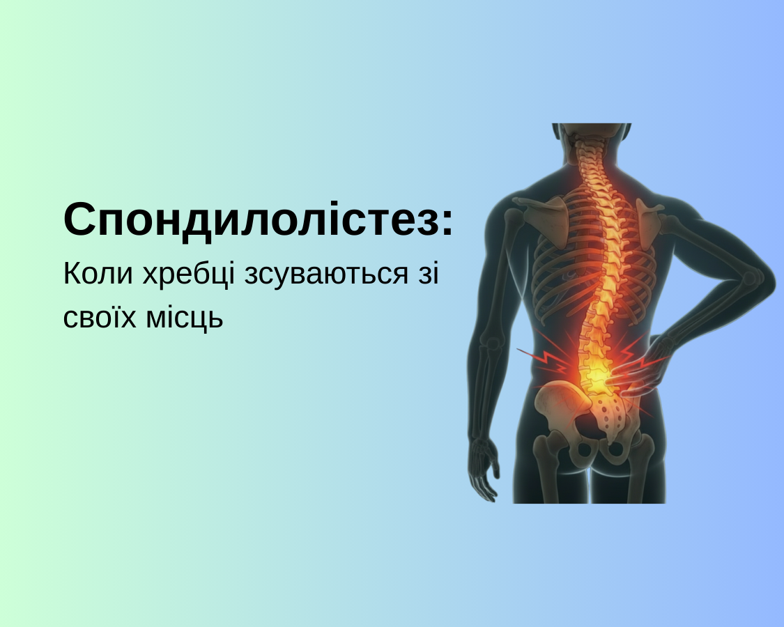 Спондилолістез: Коли хребці зсуваються зі своїх місць