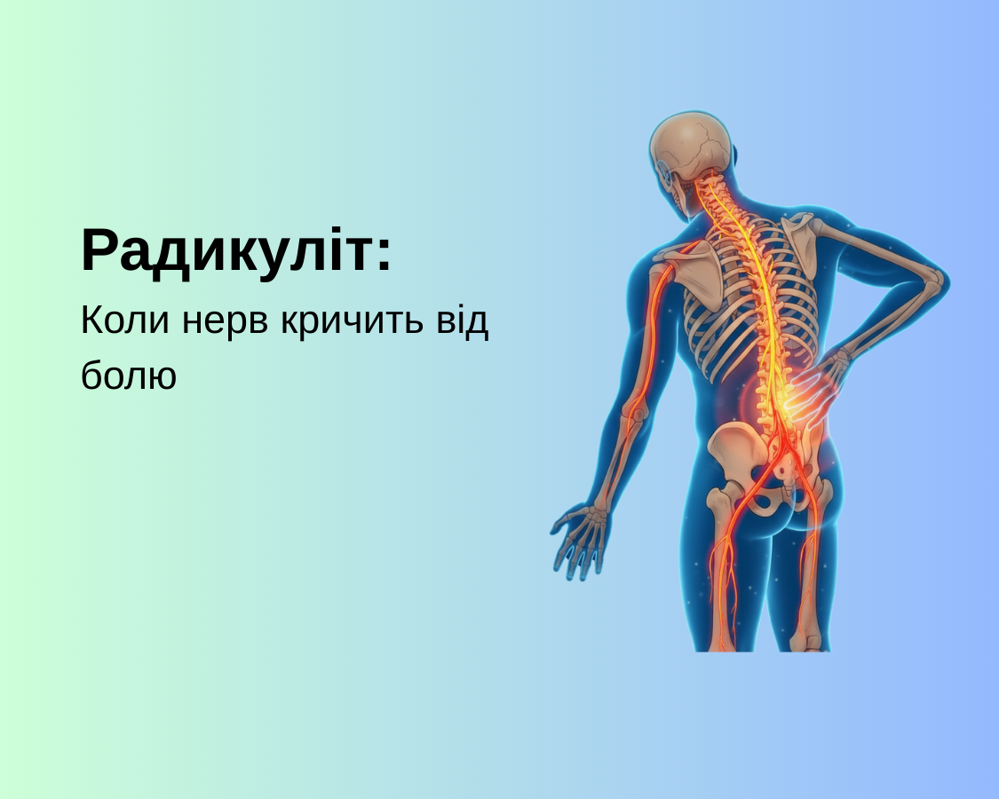 Радикуліт: Коли нерв кричить від болю