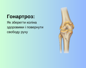 Гонартроз: Як зберегти коліна здоровими і повернути свободу руху