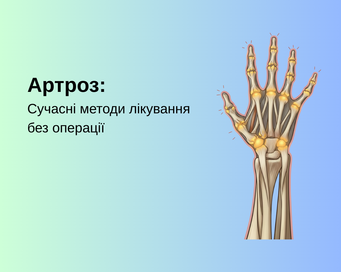 Артроз: Сучасні методи лікування без операції