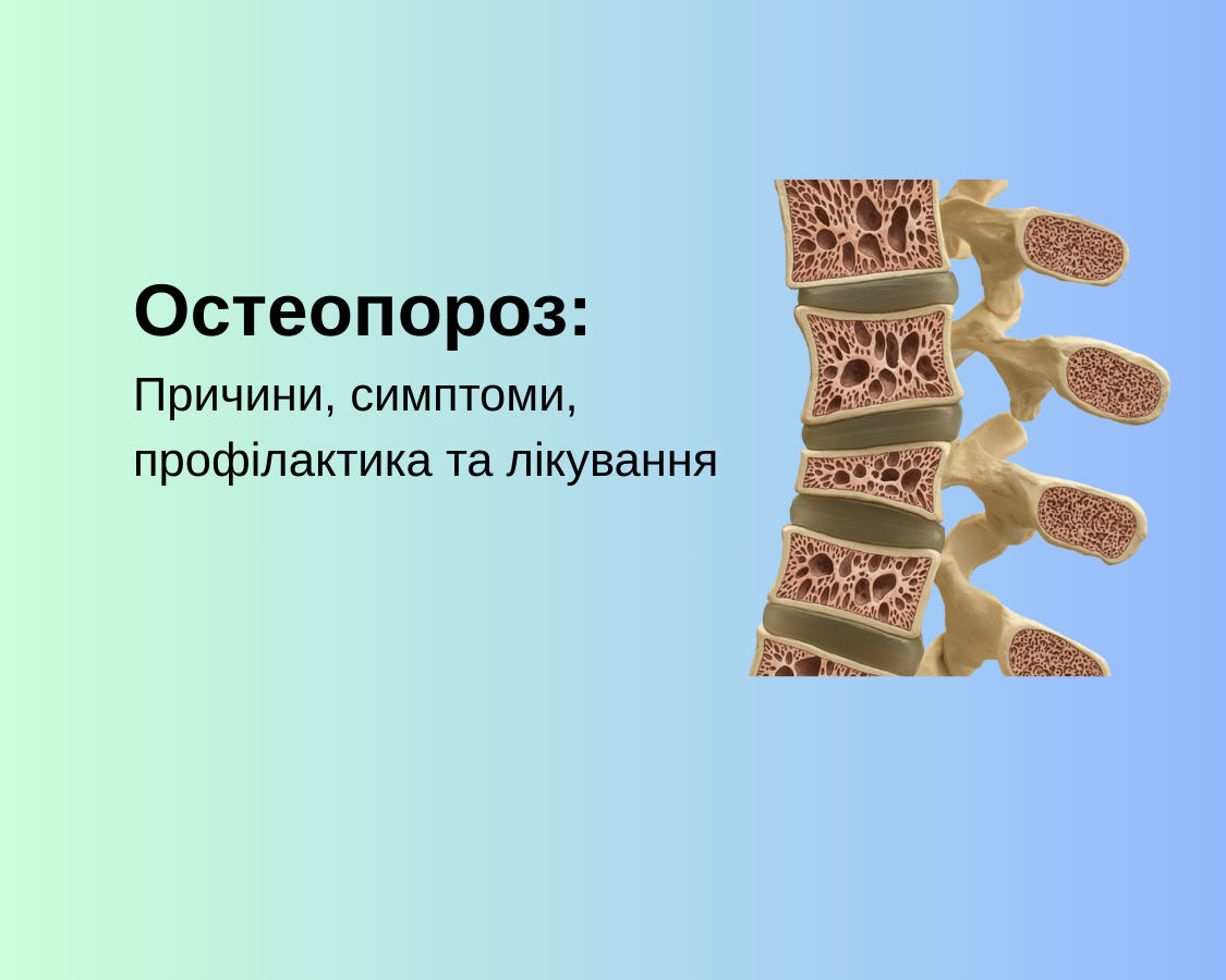 Остеопороз: Причини, симптоми, профілактика та лікування